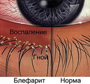 Демодекозный блефарит симптомы
